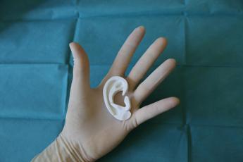 Ricostruito orecchio a un bambino grazie alla stampa 3D